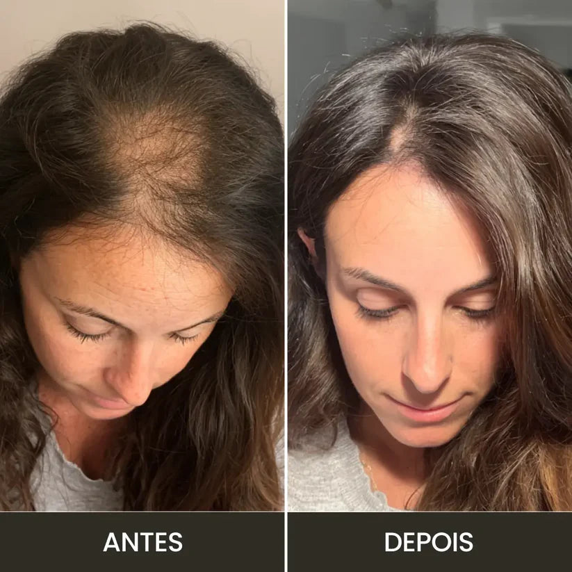 Kit de Alta Frequencia Profissional para Tratamento Capilar e Facial Haute™