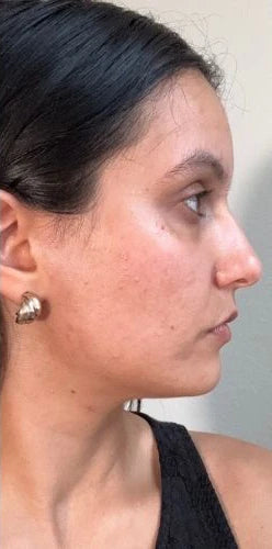 Acne reduzida e pele mais lisa