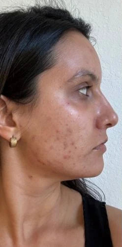 Acne reduzida e pele mais lisa