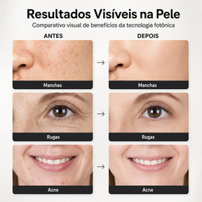 Aparelho de Fototerapia LED Facial e Corporal 7 Cores com Spray Frio IRÍDIA™